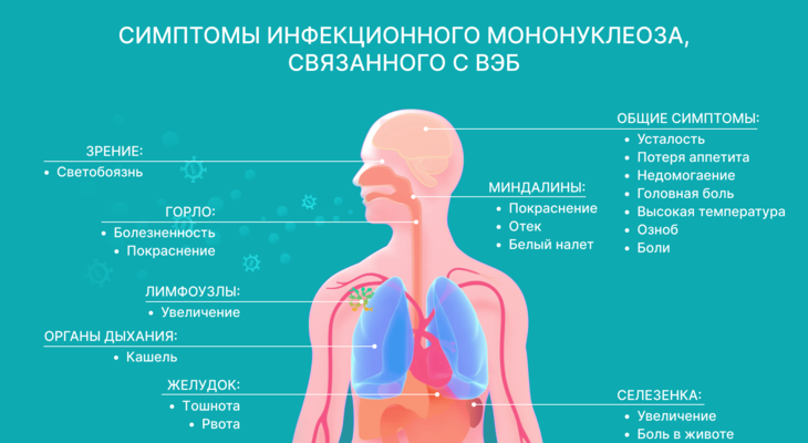 Инфекционный мононуклеоз
